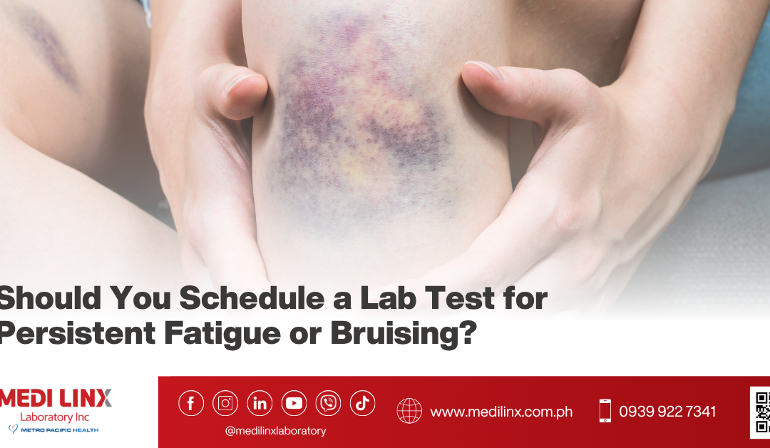 When Persistent Fatigue or Bruising May Need Laboratory Testing
